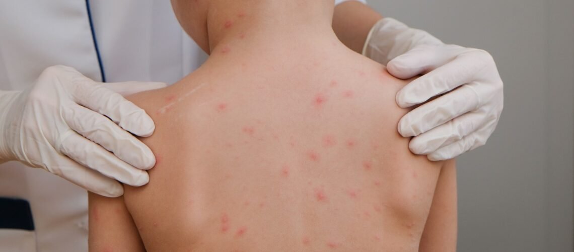 Guerrero es cuarto lugar nacional de casos de sarampión