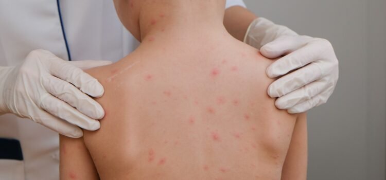 Guerrero es cuarto lugar nacional de casos de sarampión Guerrero es cuarto lugar nacional de casos de sarampión