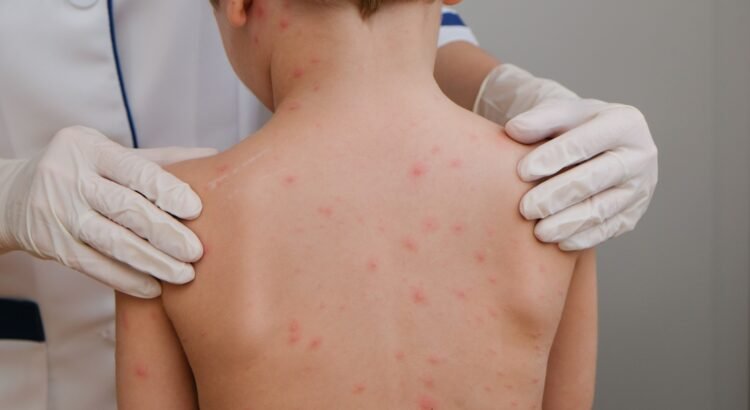 Guerrero es cuarto lugar nacional de casos de sarampión Guerrero es cuarto lugar nacional de casos de sarampión